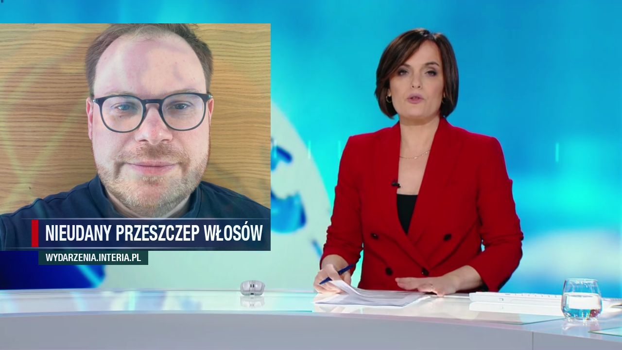 nieudany przeszczep włosów