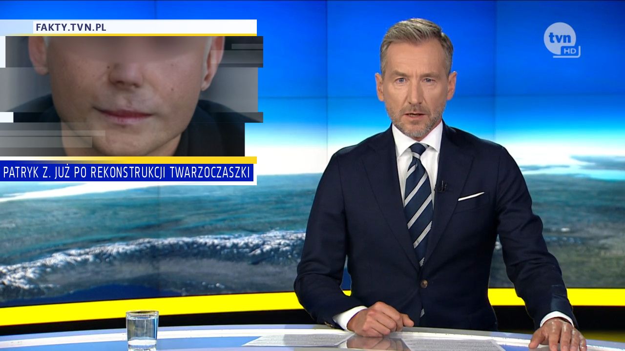 PATRYK Z. JUŻ PO REKONSTRUKCJI TWARZOCZASZKI